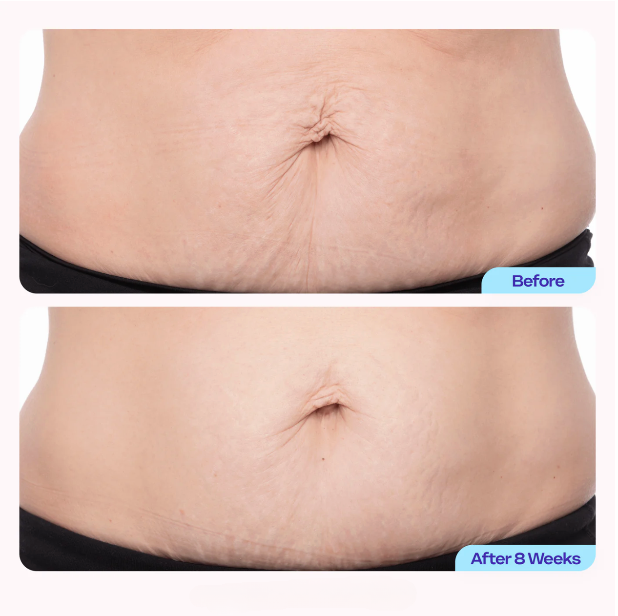 Welli BellySculpt™