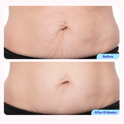 Welli BellySculpt™