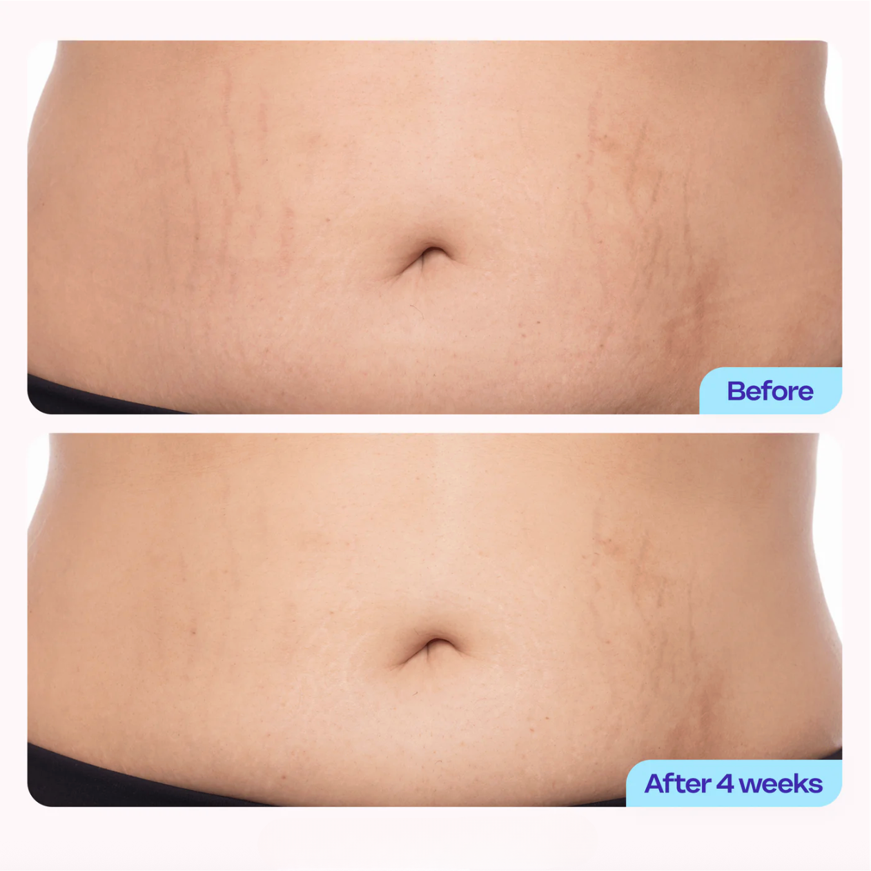 Welli BellySculpt™